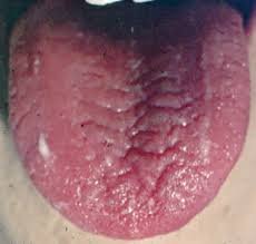 Spleen Yang Deficiency